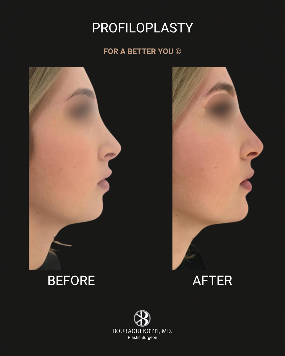 Profiloplasty — Non-Surgical Facial Contouring before Dubai
