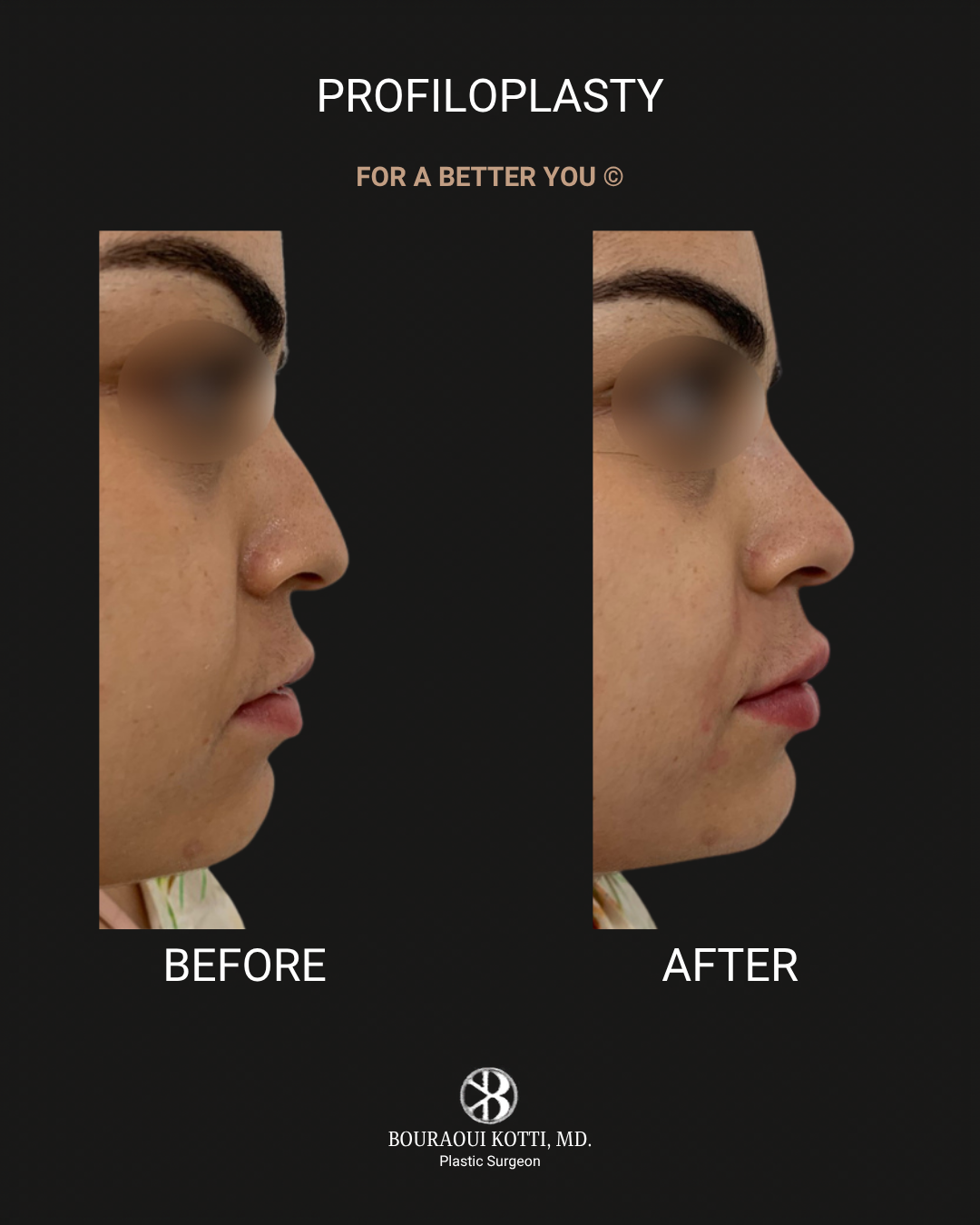 Profiloplasty — Non-Surgical Facial Contouring after Dubai
