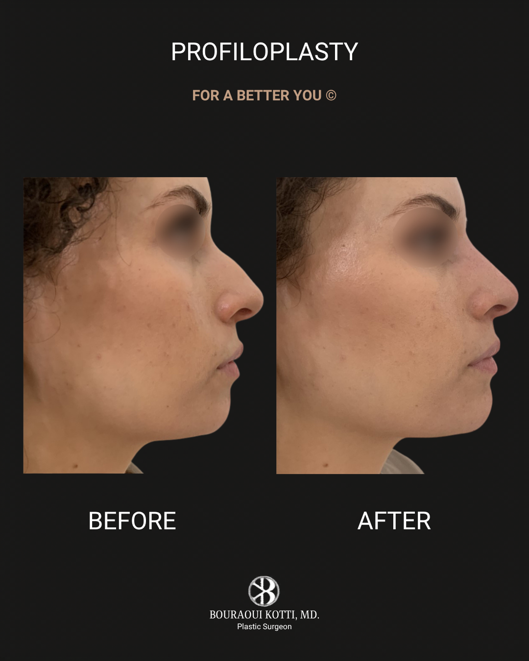 Profiloplasty — Non-Surgical Facial Contouring before Dubai