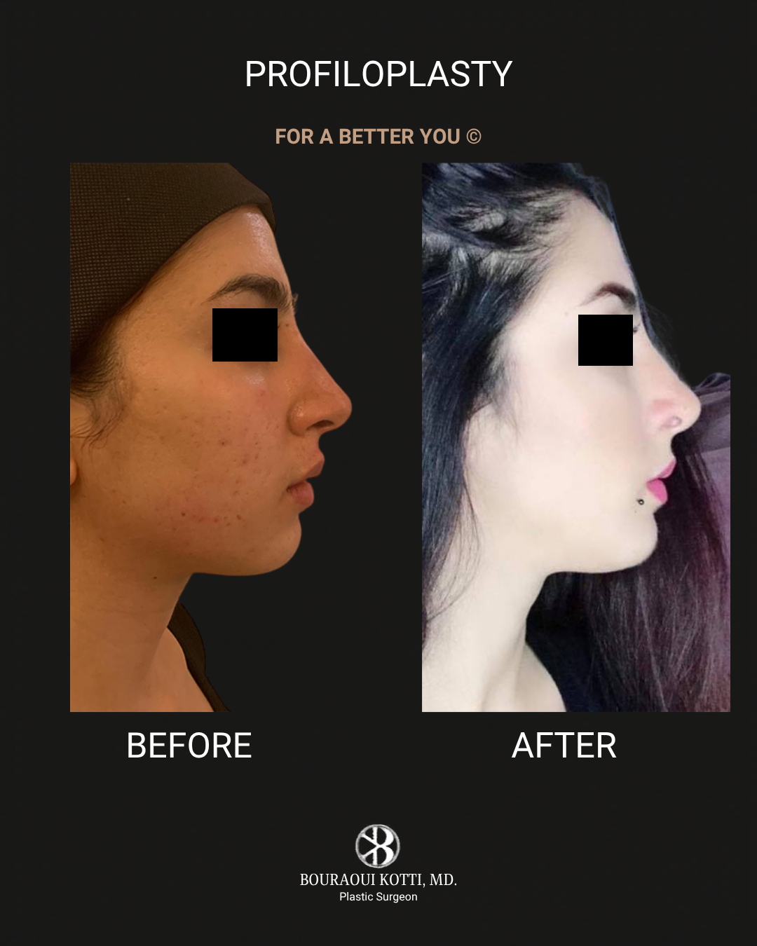 Profiloplasty — Non-Surgical Facial Contouring after Dubai
