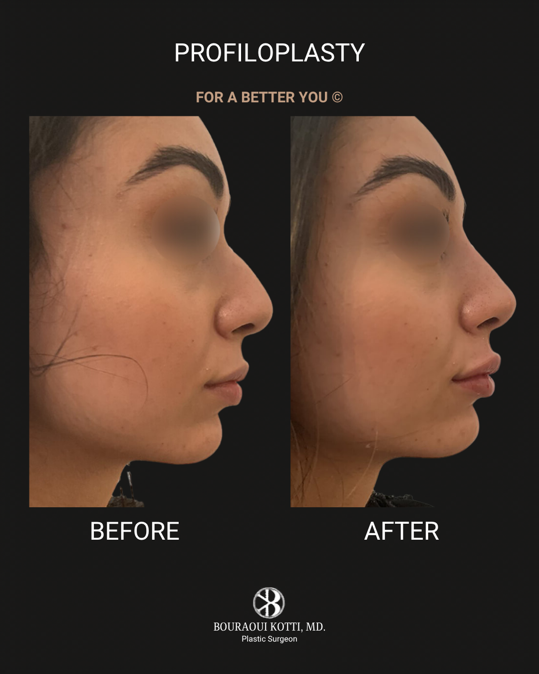 Profiloplasty — Non-Surgical Facial Contouring before Dubai