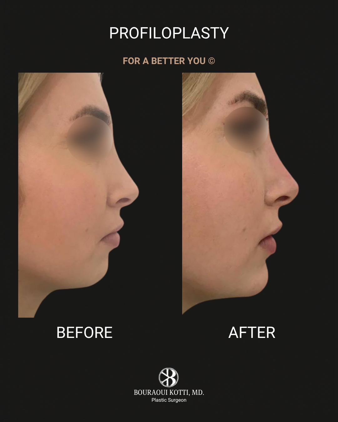 Profiloplasty — Non-Surgical Facial Contouring after Dubai