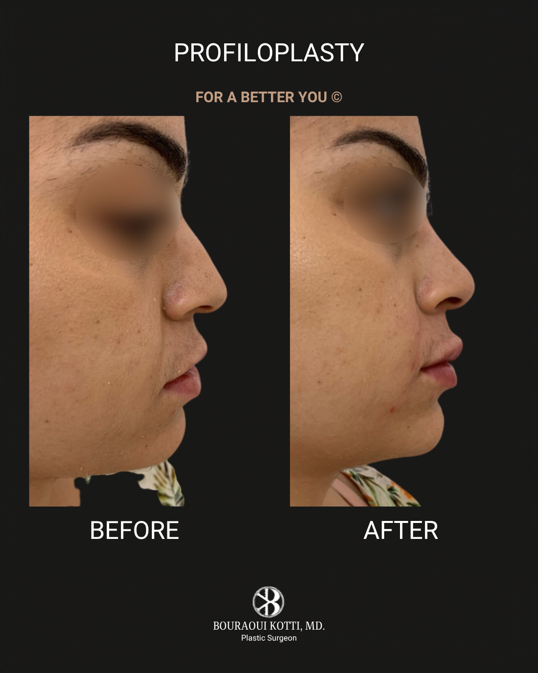 Profiloplasty — Non-Surgical Facial Contouring before Dubai