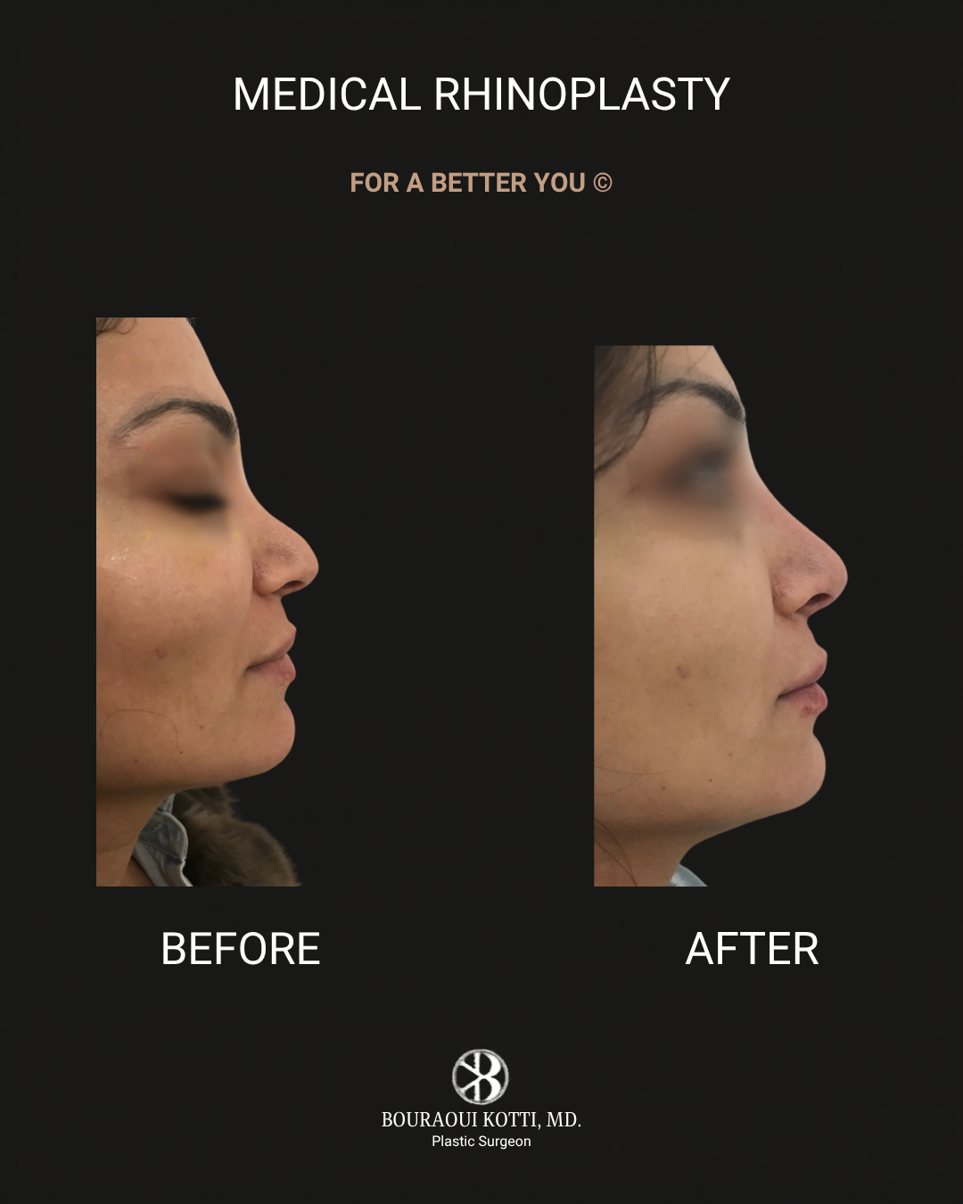 Rhinoplasty before Dubai