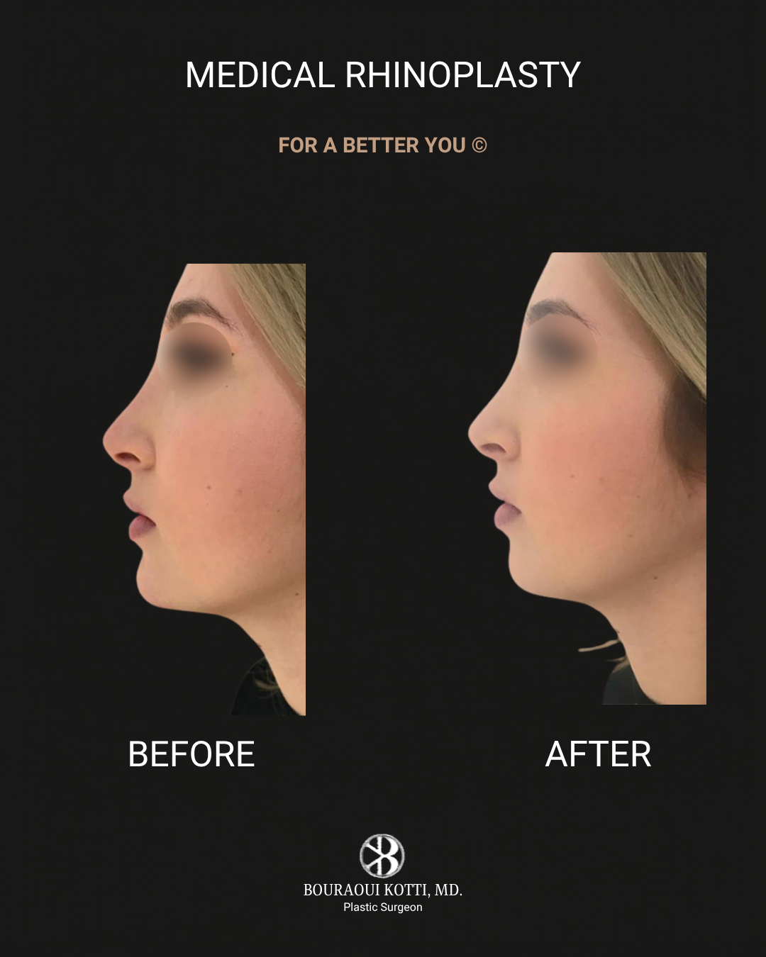Rhinoplasty after Dubai