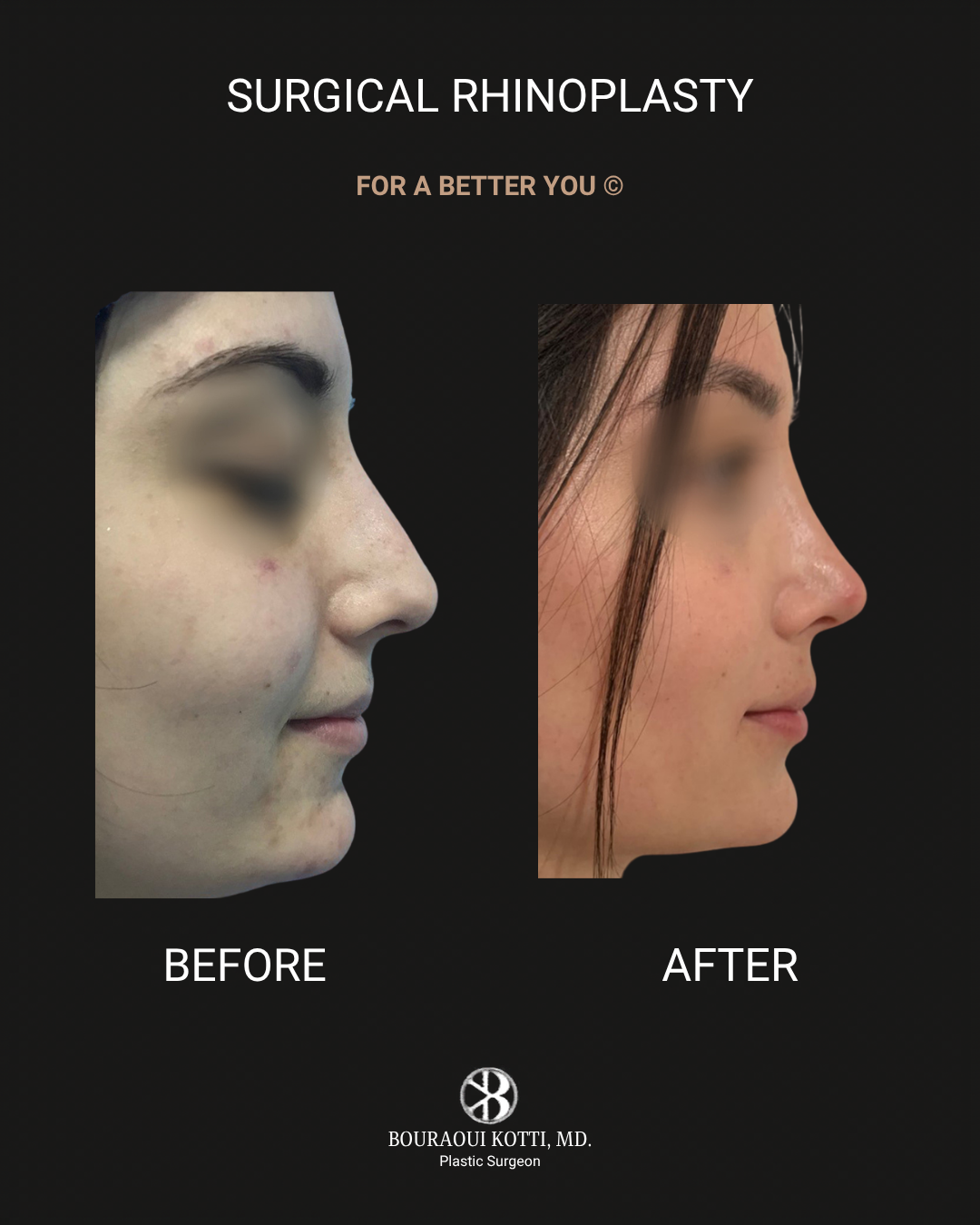 Rhinoplasty before Dubai