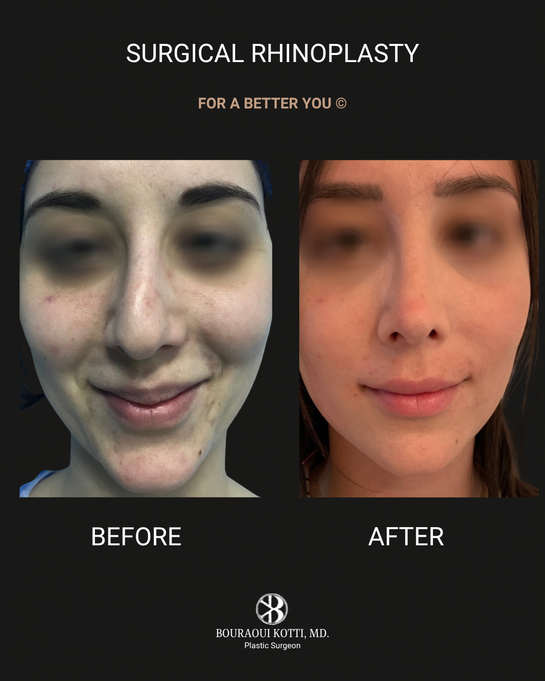 Rhinoplasty after Dubai