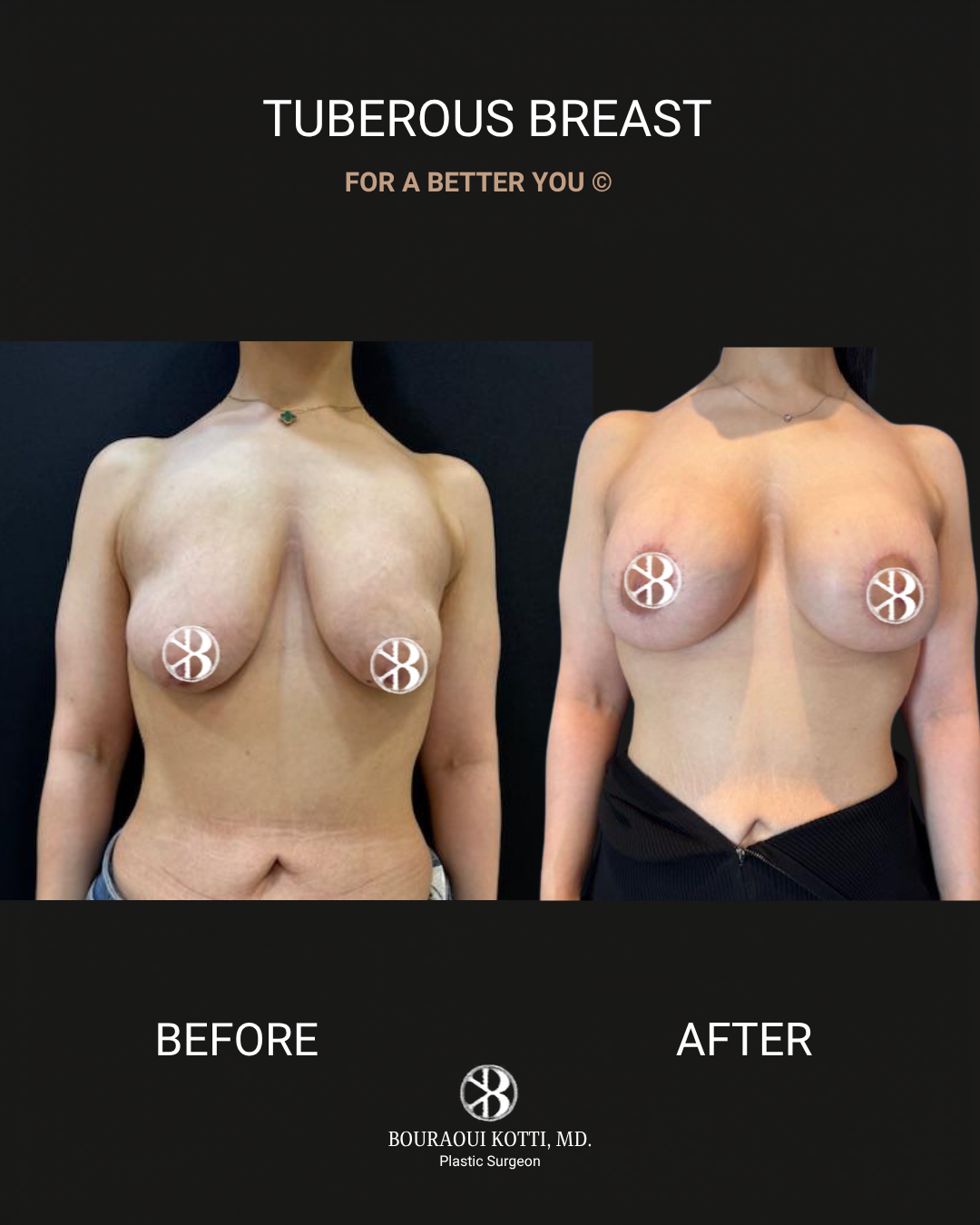 Tuberous Breasts before Dubai
