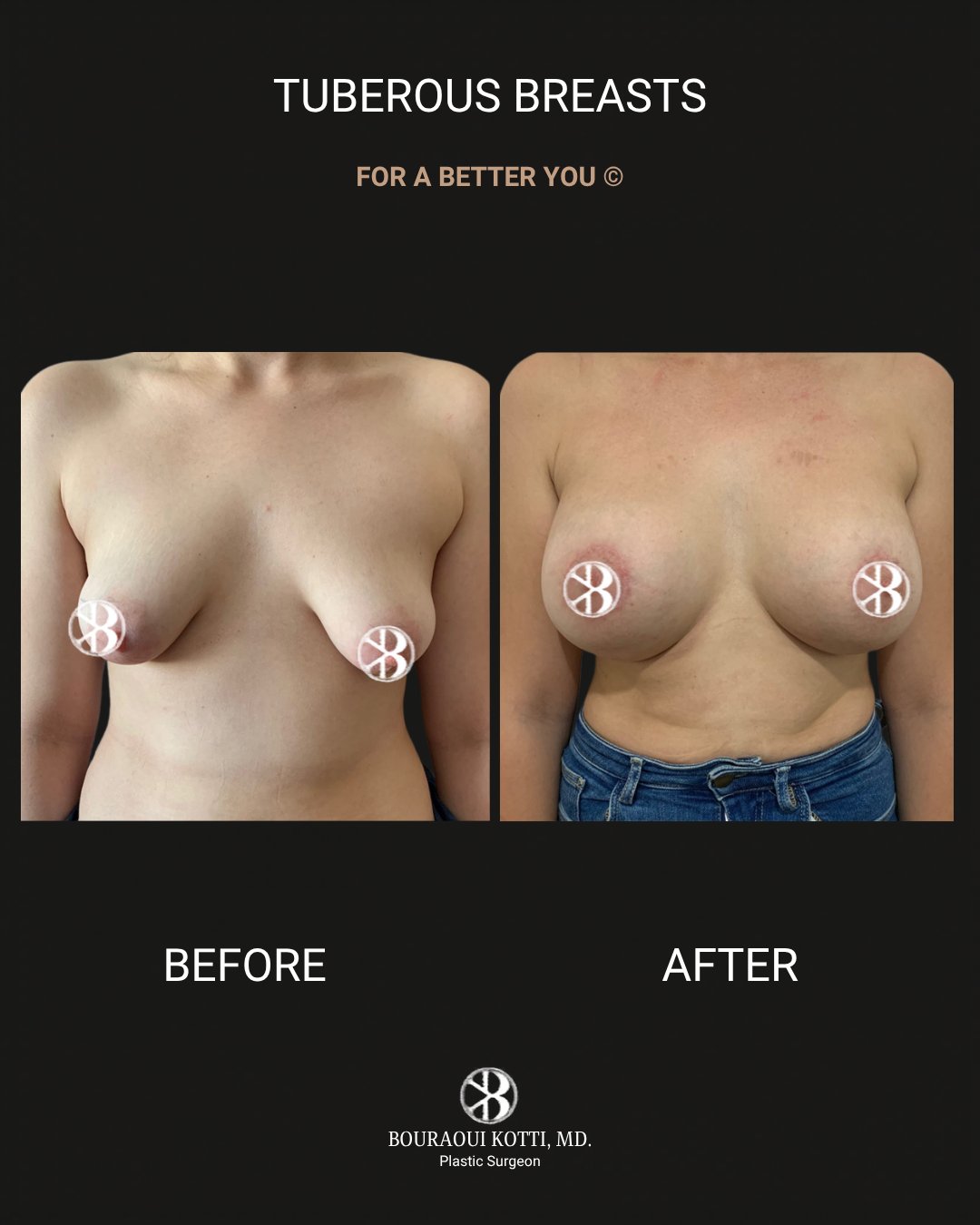 Tuberous Breasts before Dubai
