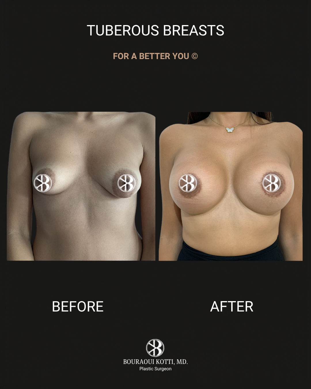 Tuberous Breasts after Dubai